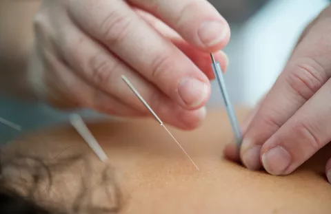 Accupuncture